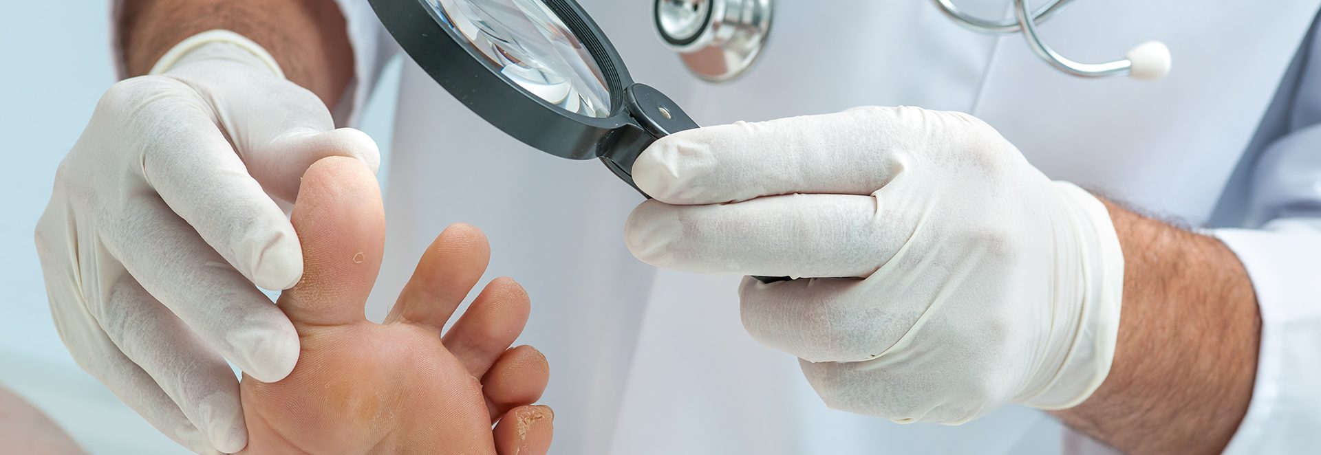 פטרת ציפורניים